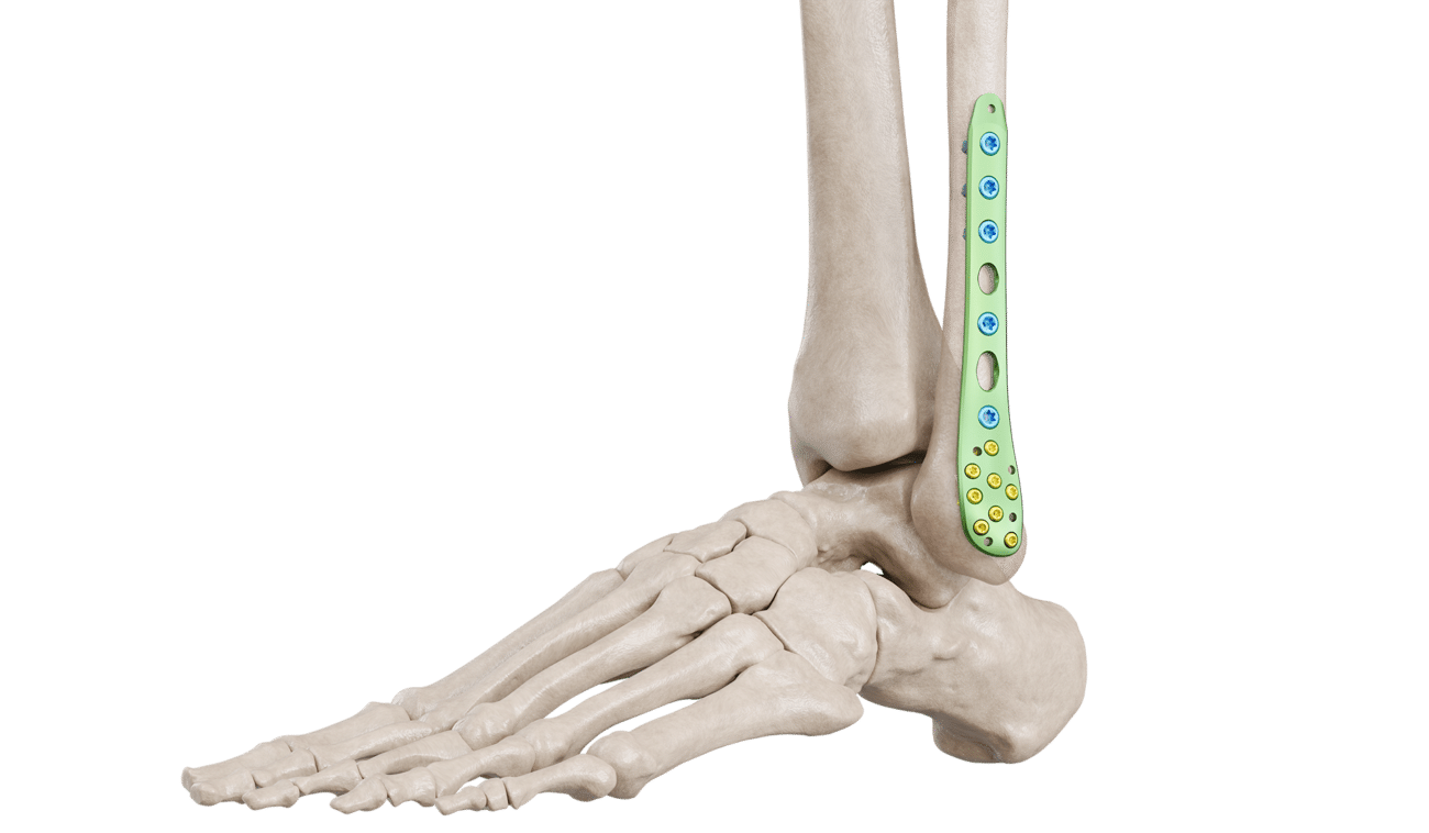 Distal Fibula Lateral Malleolar Anatomik Plak