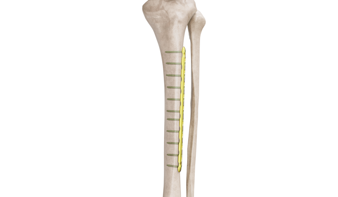 4.5 mm Tibia Düz Plak