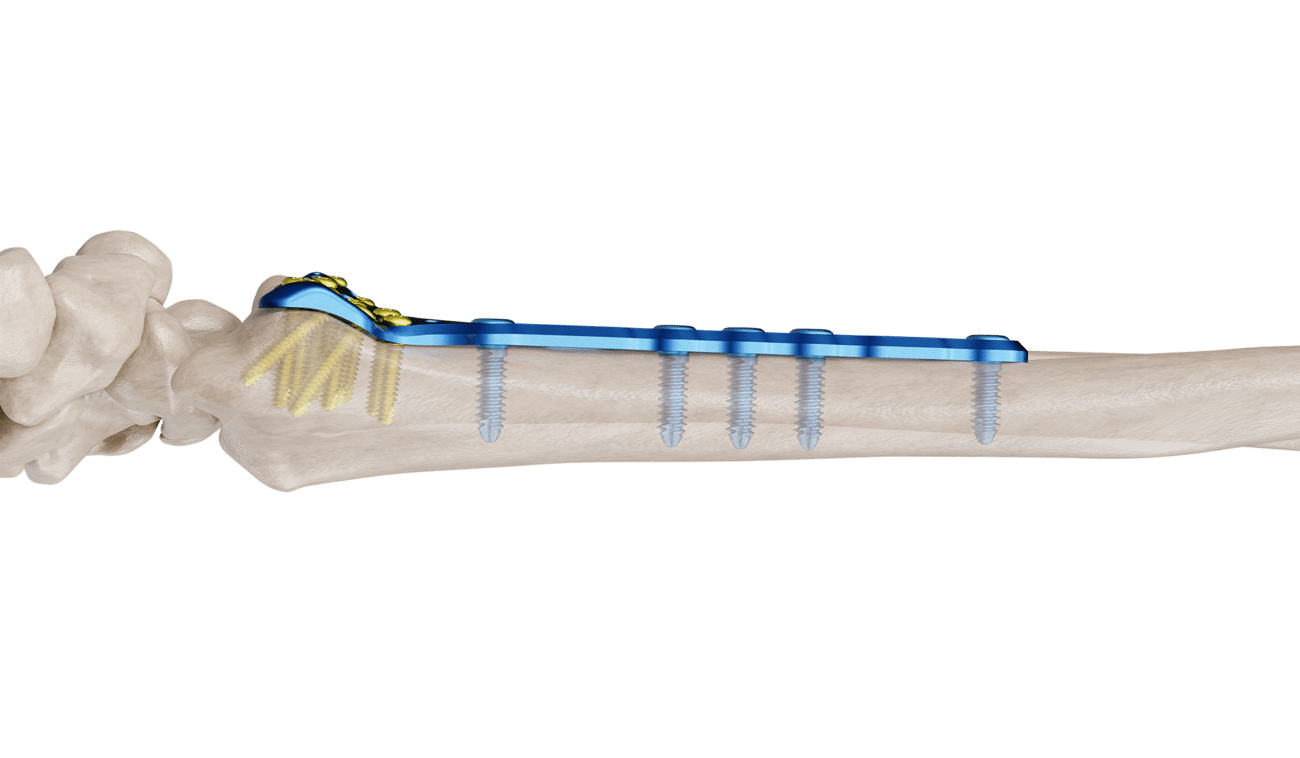 Distal Radyus Volar Anatomik Geniş Plak