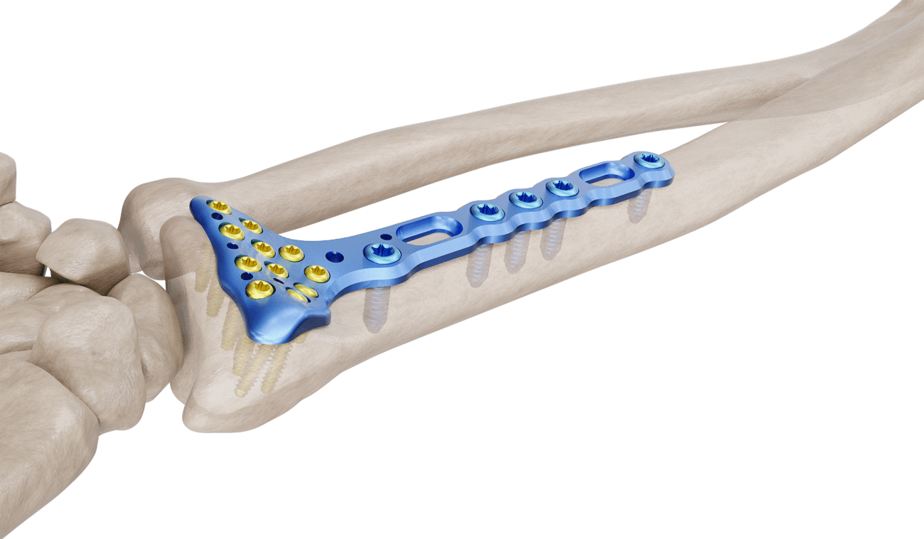 Distal Radyus Volar Anatomik Geniş Plak