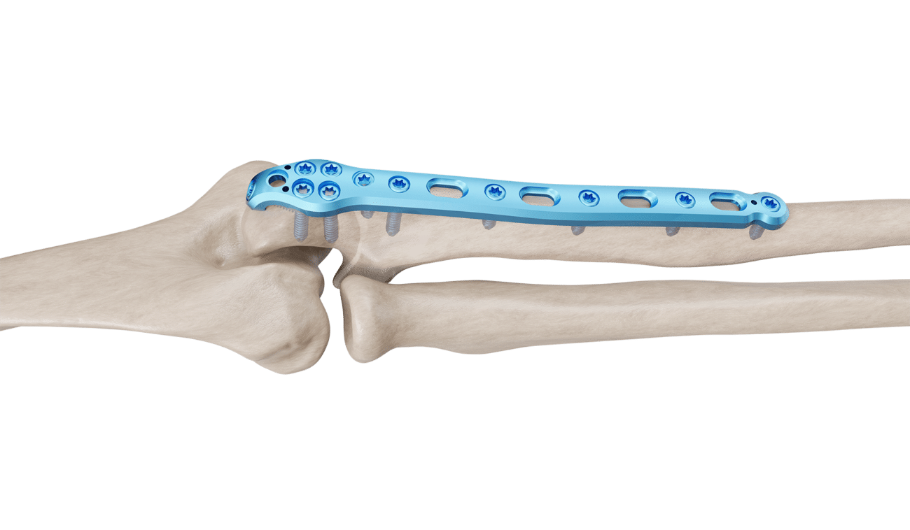 Olecranon Anatomik Plak