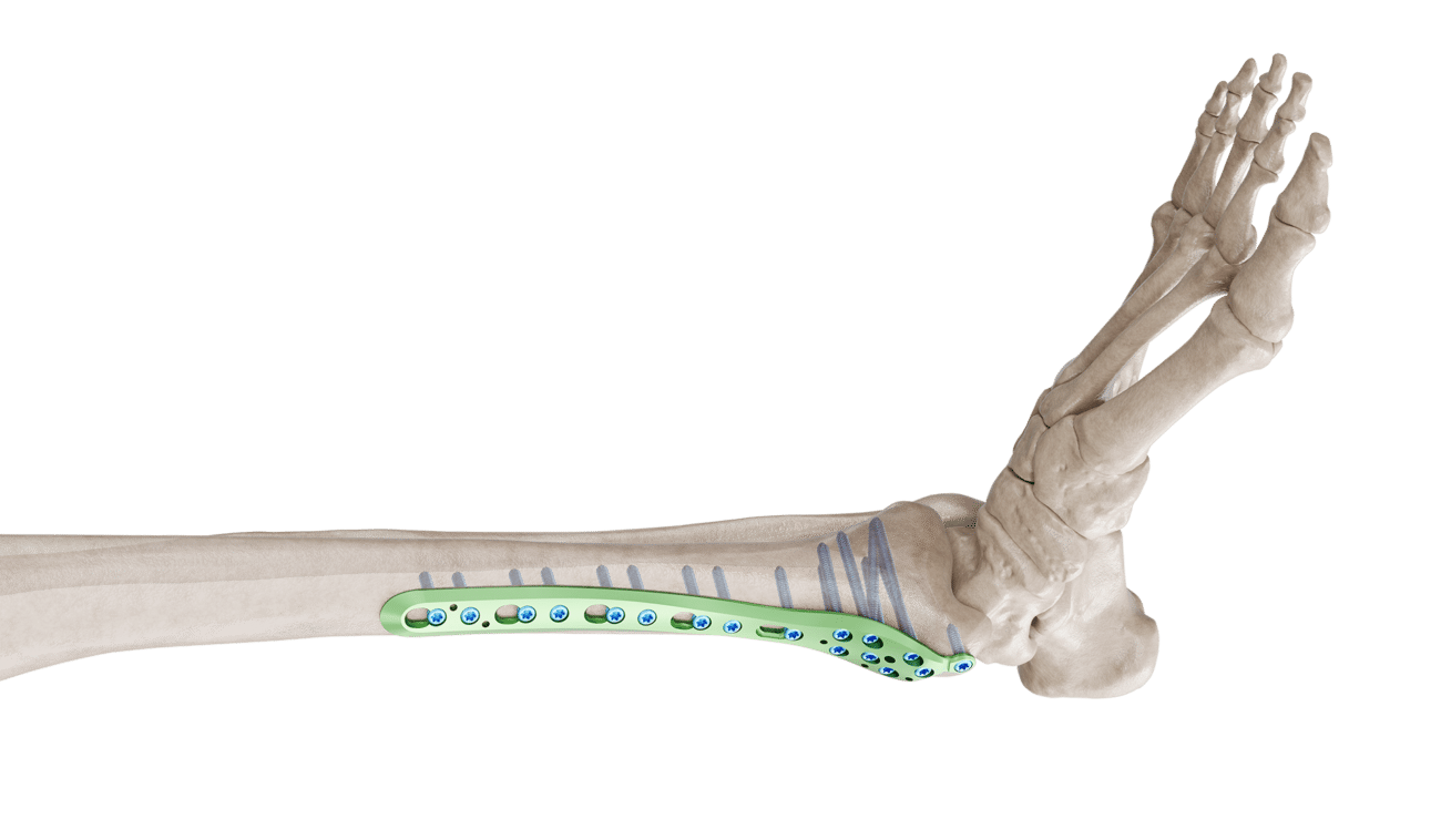Distal Tibia Medyal Anatomik Plak