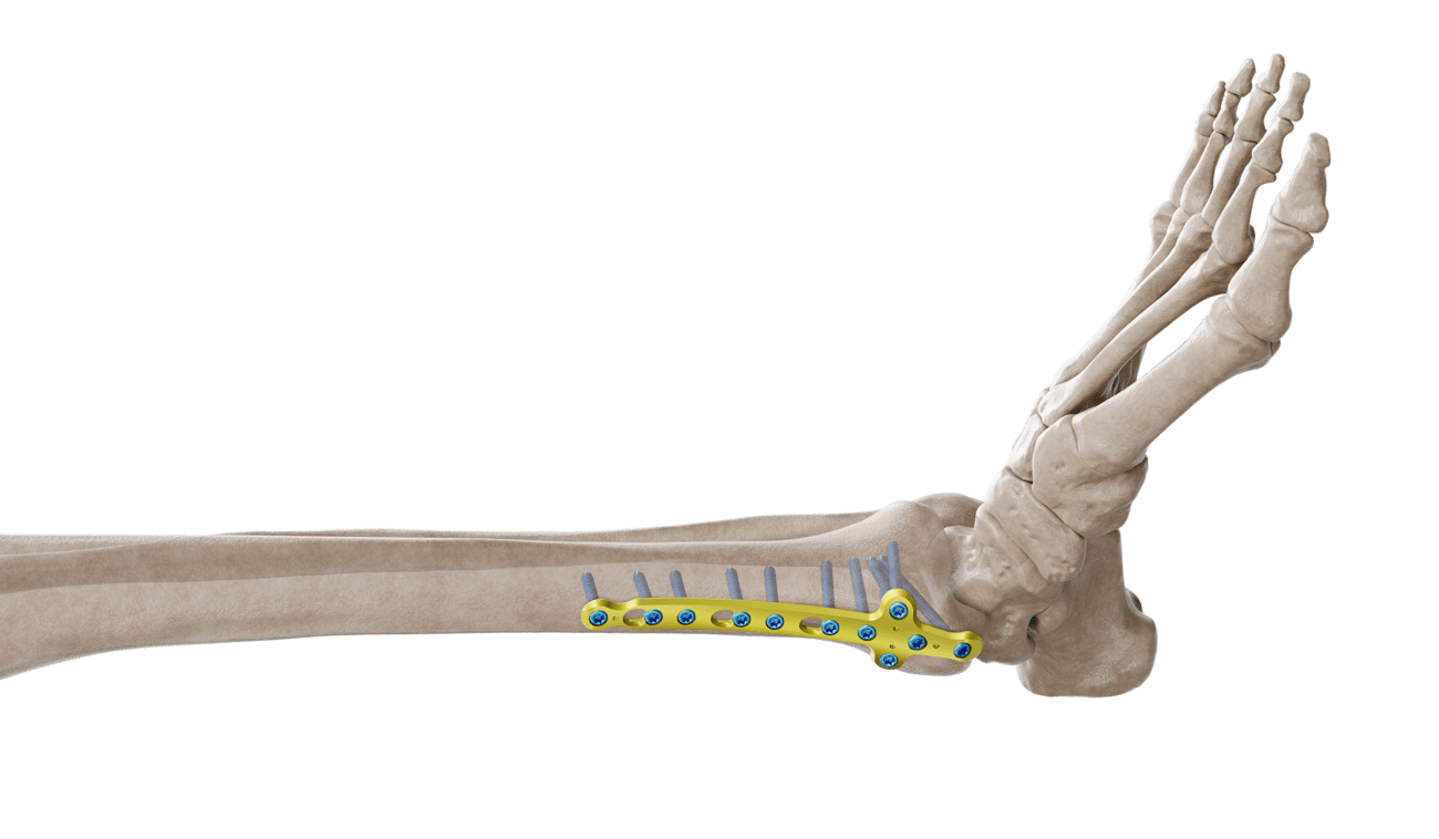Distal Tibia Medyal Malleolar Plak