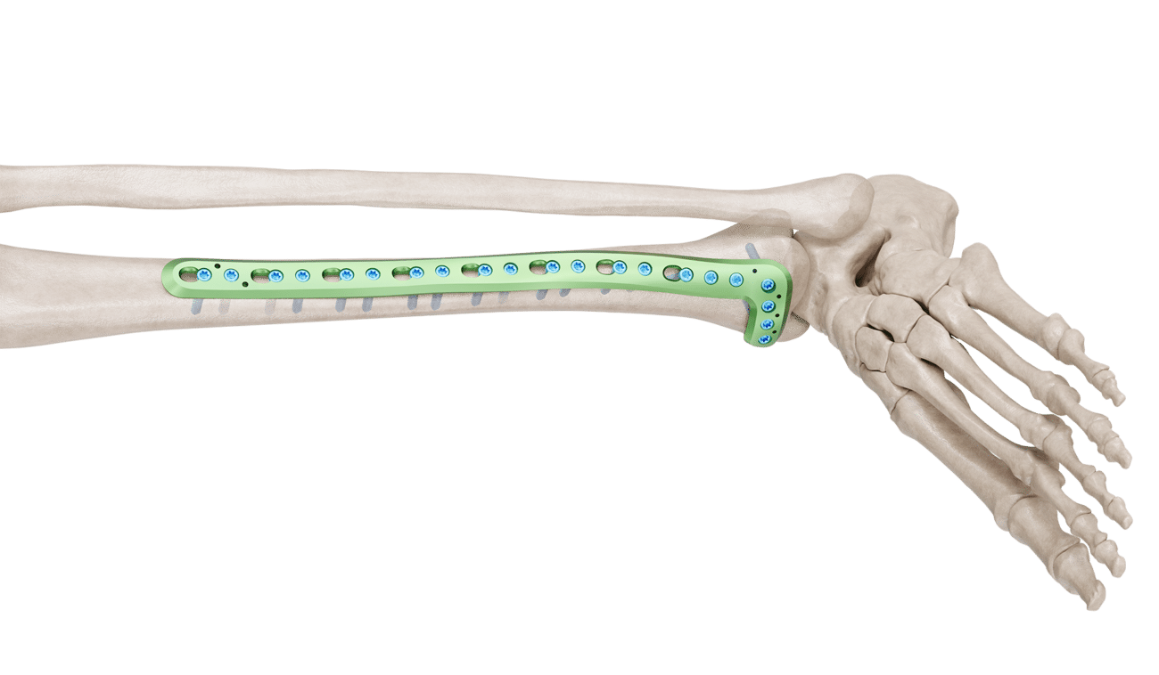 Distal Tibia Anterolateral Anatomik Plak