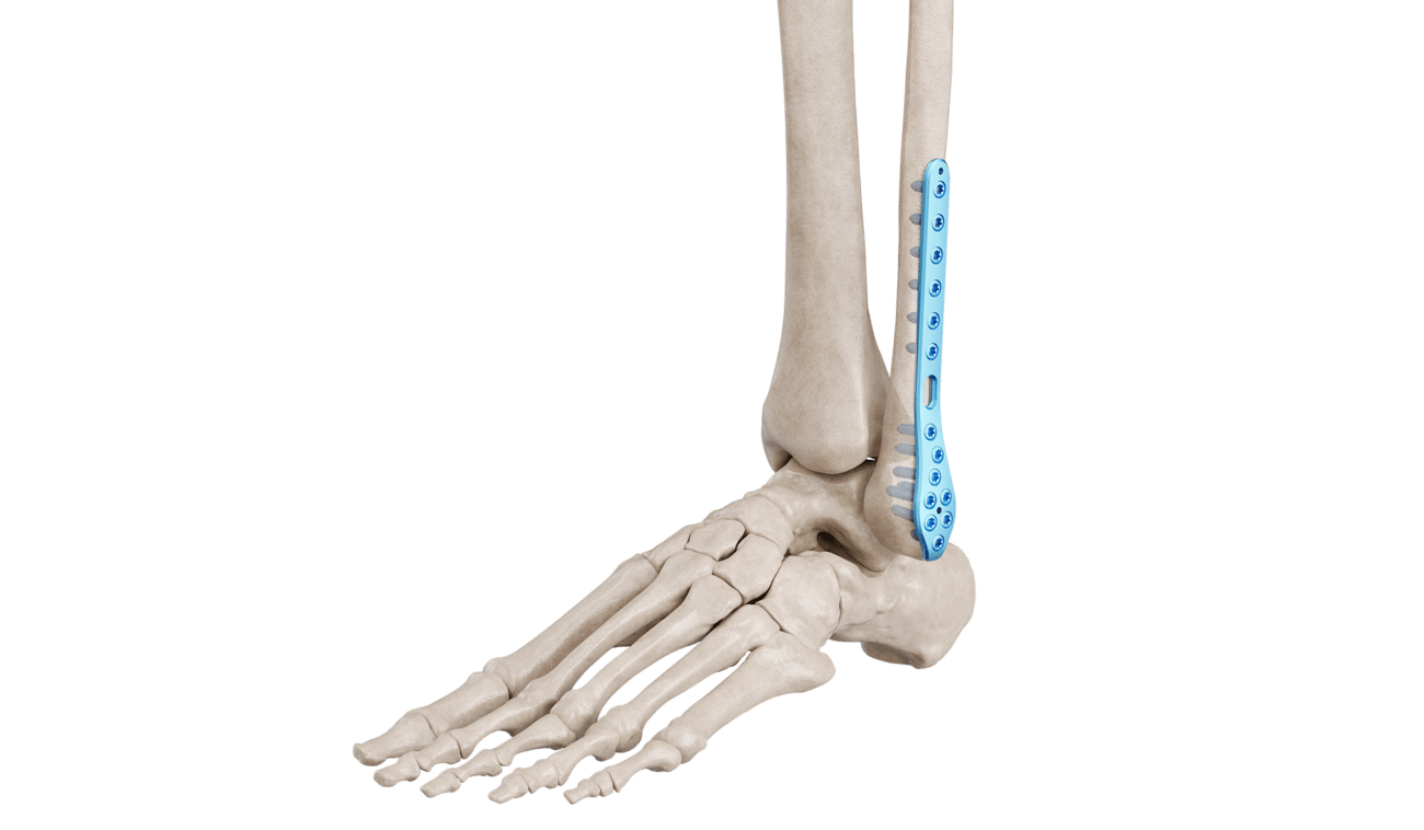 Distal Fibula Plak
