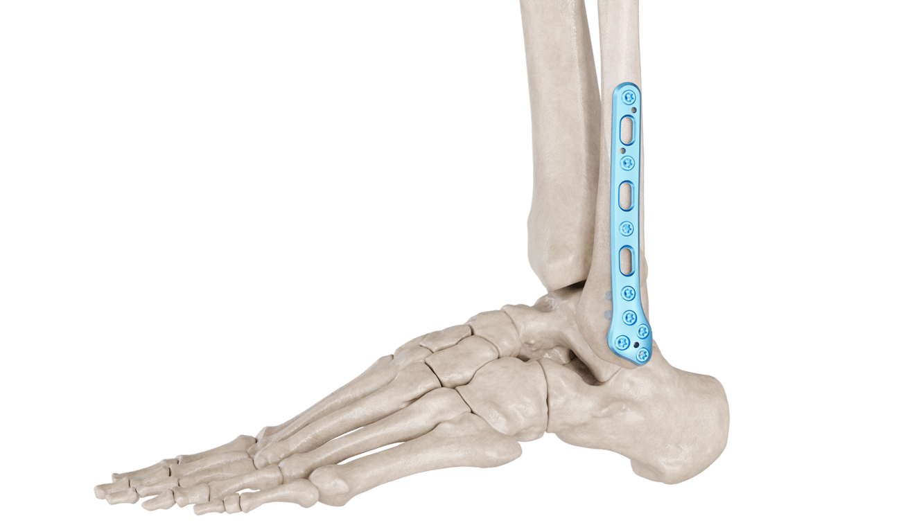 Distal Fibula Posterolateral Anatomik Plak