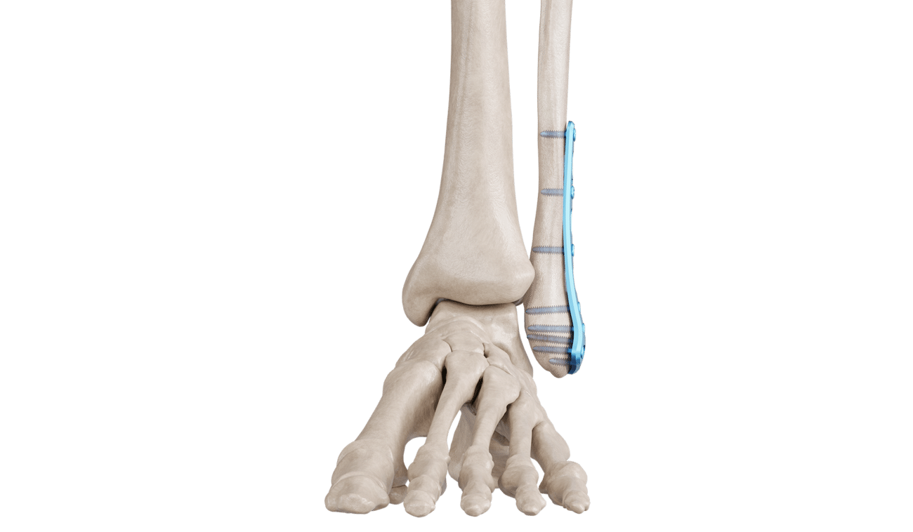 Distal Fibula Posterolateral Anatomik Plak