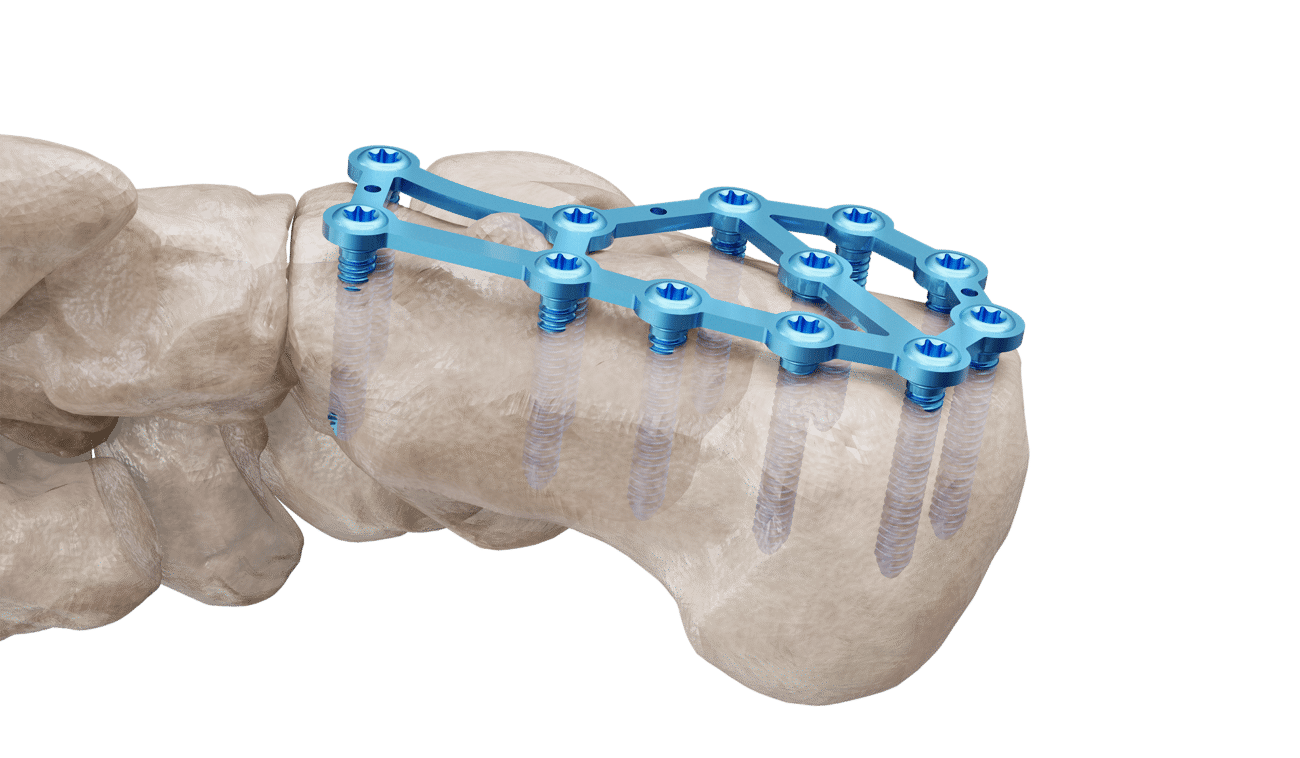 Calcaneus Plak