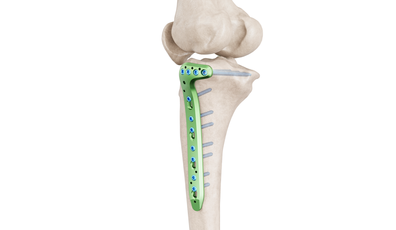 Proksimal Tibia Lateral Anatomik Plak