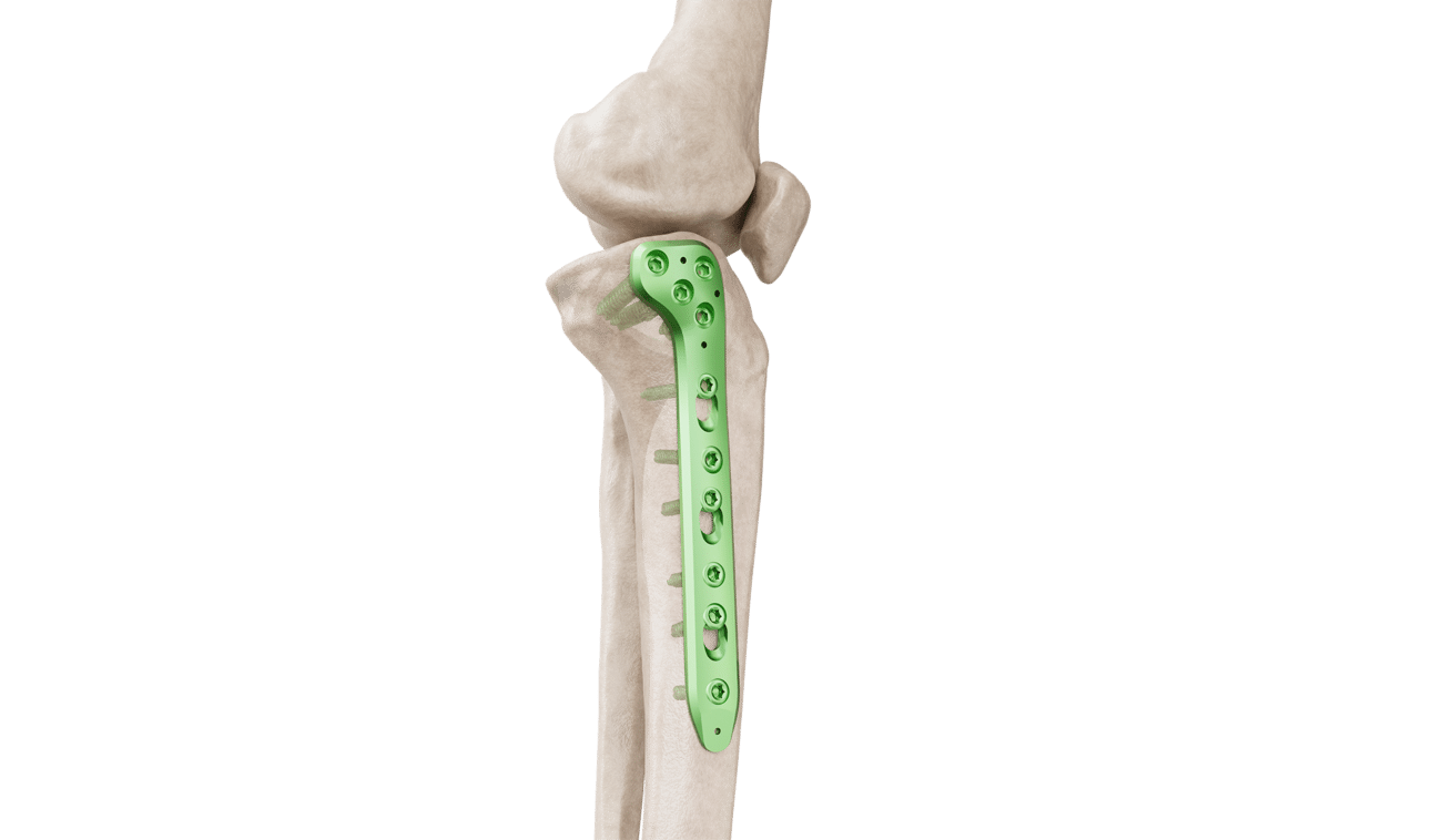 4.5 mm Proksimal Tibia Medyal Anatomik Plak