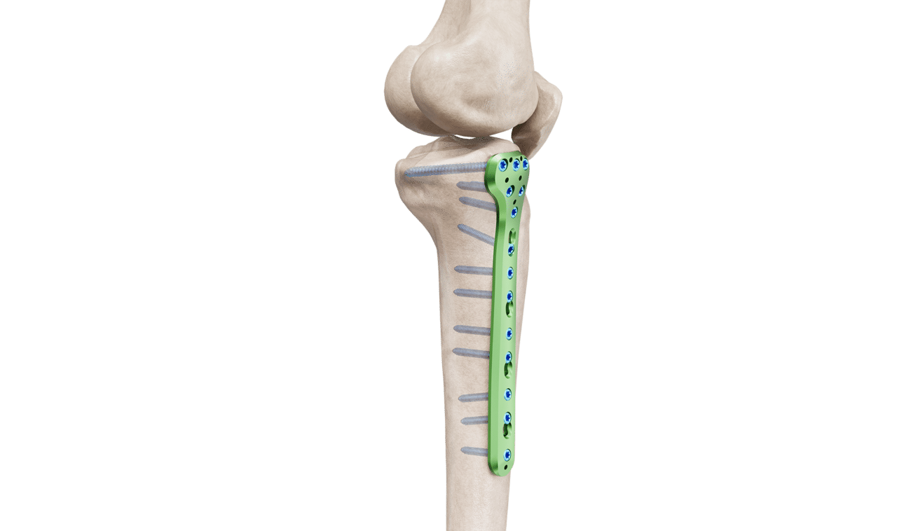 Proksimal Tibia Medyal Anatomik Plak