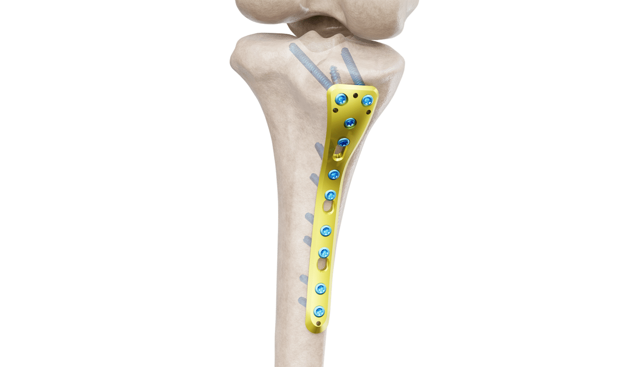 Proksimal Tibia Posteromedyal Plak