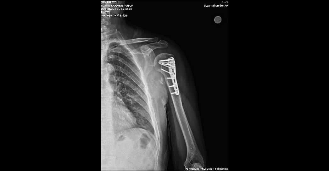Proksimal Humerus Plak