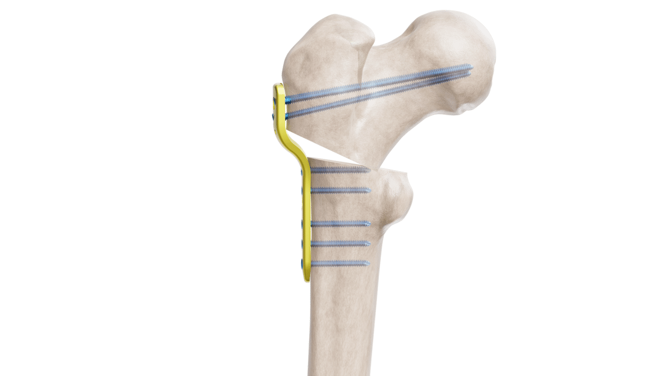 Pediatrik Kalça Proksimal Femur Plak