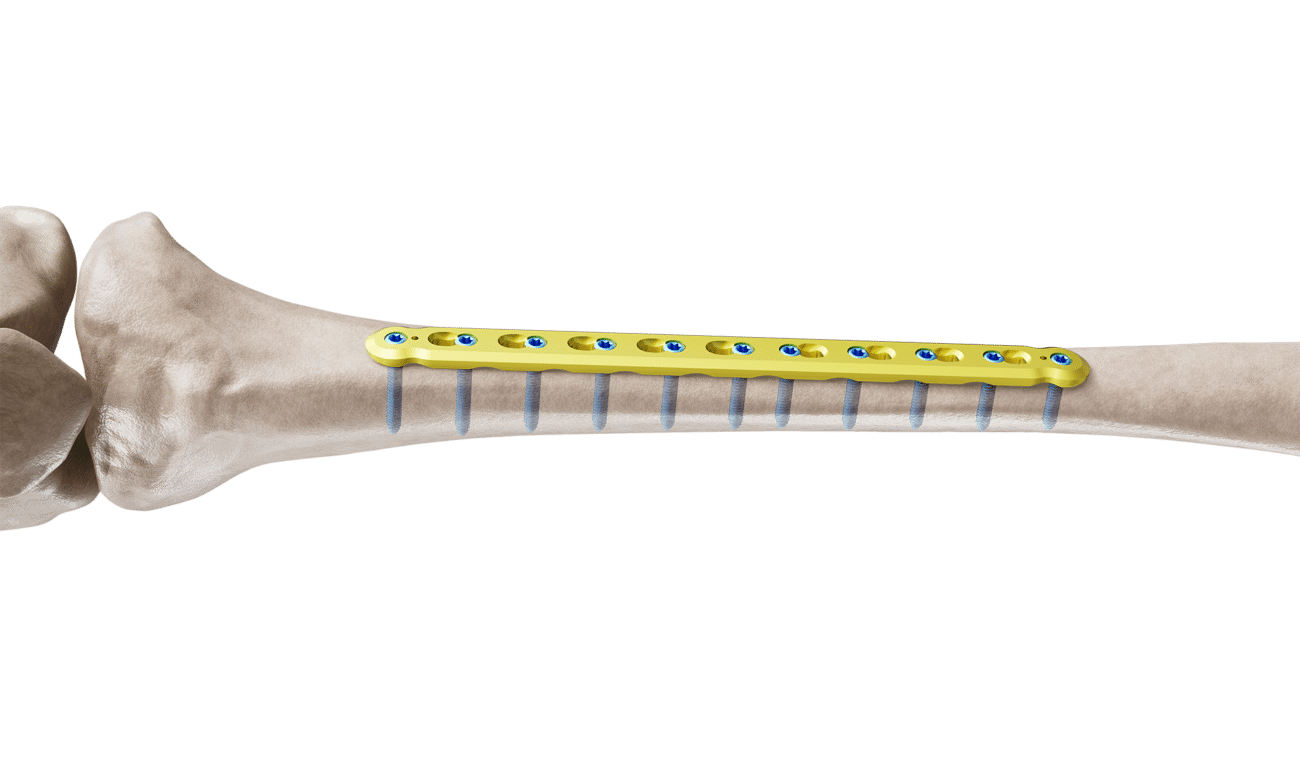 Tibia Düz Plak