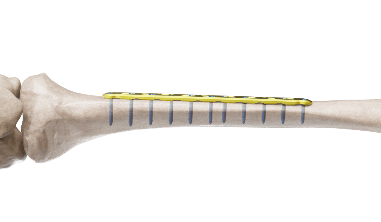 Tibia Düz Plak