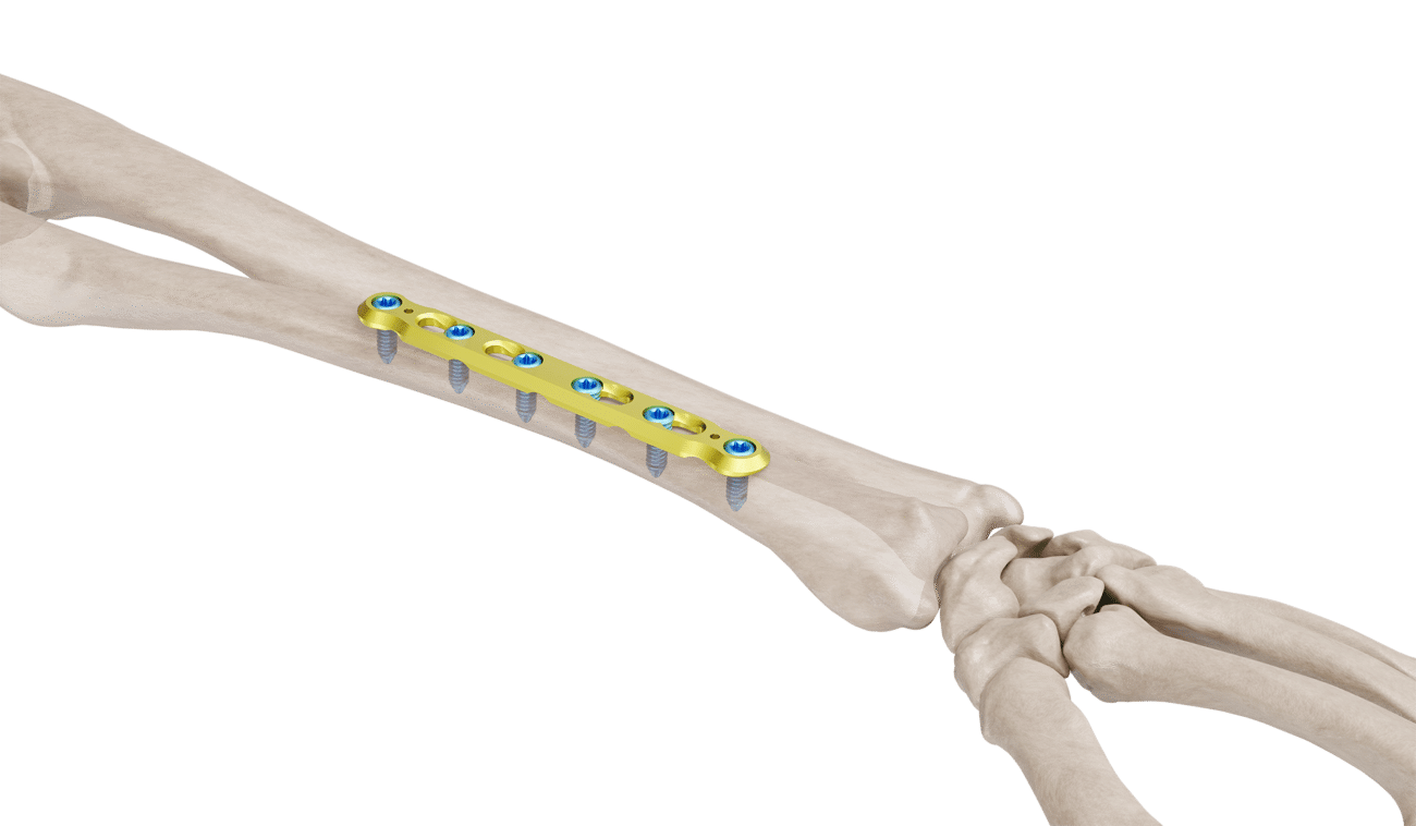 3.5 mm Ulna Radyus Plak