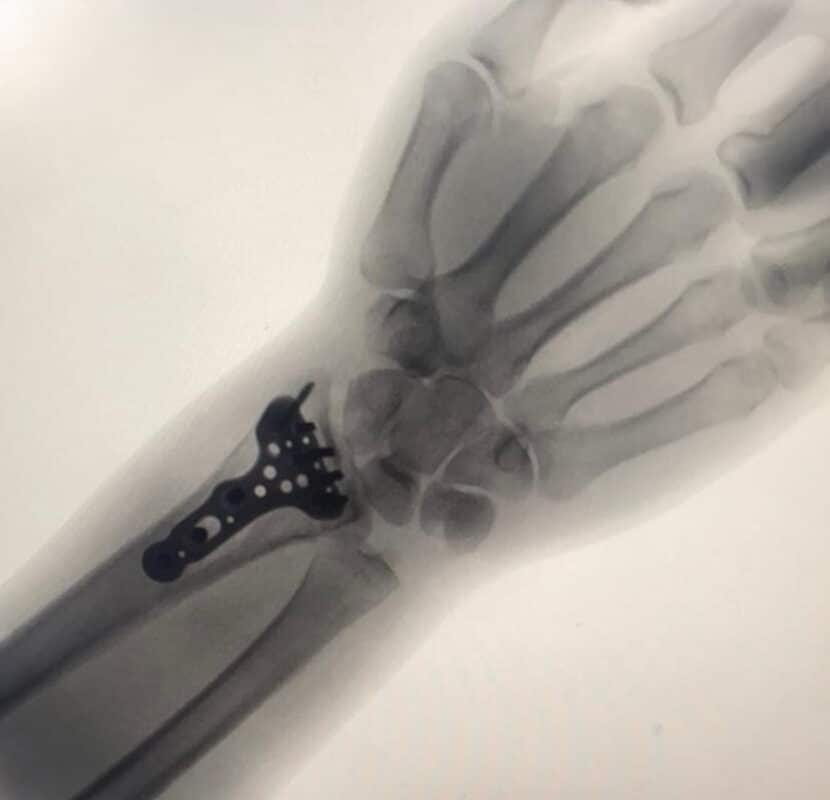 Distal Radyus Volar Anatomik Geniş Plak