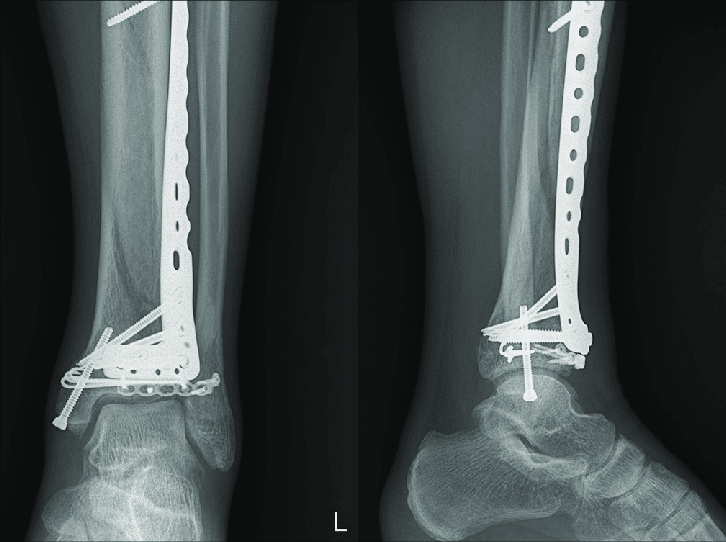 Distal Tibia Anterolateral Anatomik Plak