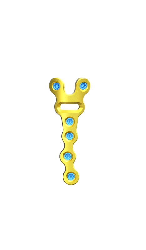 2.0 mm Mini Plaklar