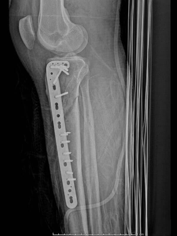 Proksimal Tibia Lateral Anatomik Plak
