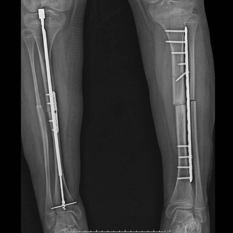 4.5 mm Tibia Düz Plak
